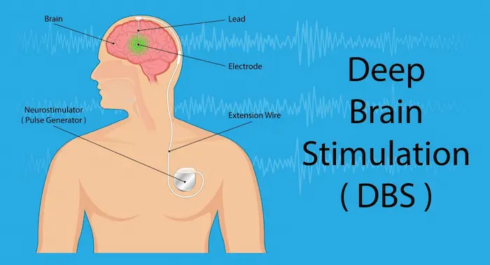Deep Brain Stimulation DBS 1200 scaled 1